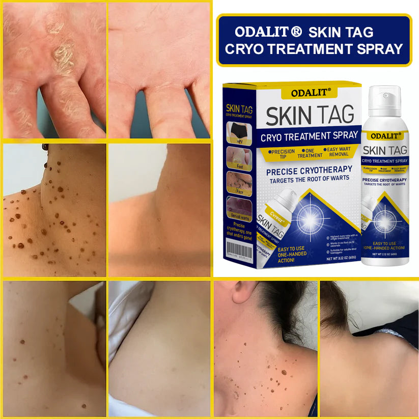 ❄️ ODALIT®: The Dermatologist-Grade Spray That Freezes Away Skin Tags & Warts.