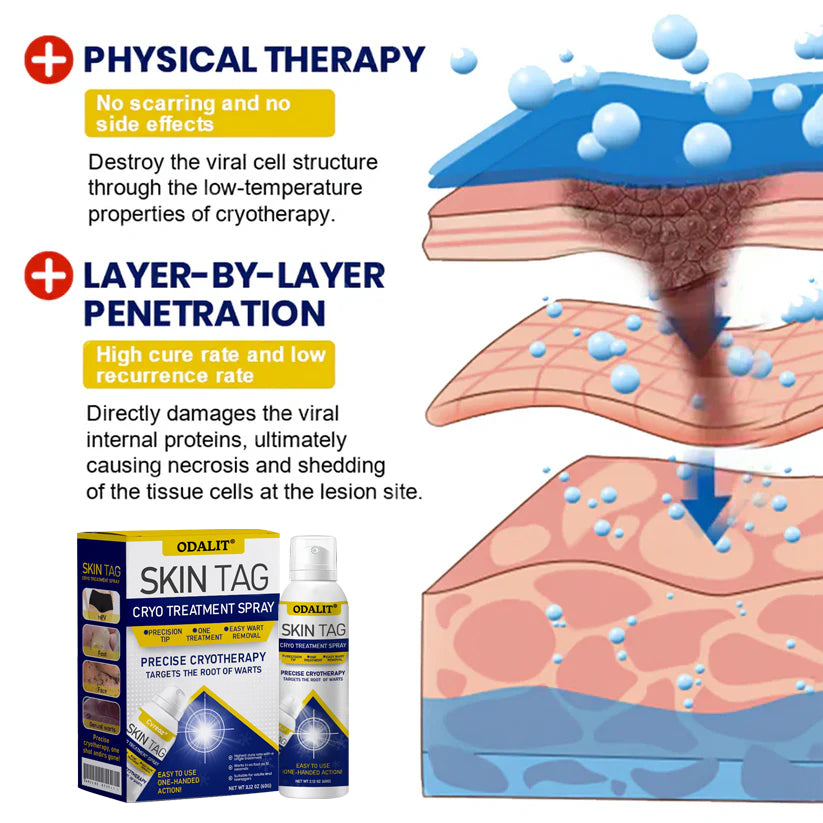 ❄️ ODALIT®: The Dermatologist-Grade Spray That Freezes Away Skin Tags & Warts.