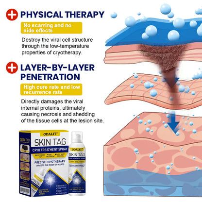 ❄️ ODALIT®: The Dermatologist-Grade Spray That Freezes Away Skin Tags & Warts.