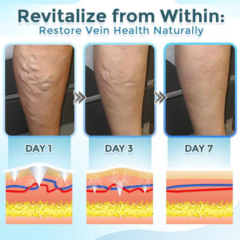 ODEIUN™ VenaRestore MicroNeedle Vein Repair Patch | 💙 Varicose Vein Relief ✨ Circulation Support 🦵 Leg Care [Official Flagship Store]