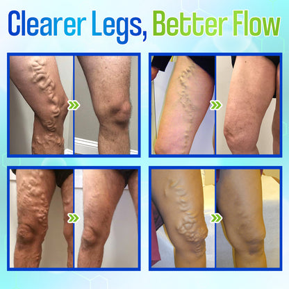 🎁 ODEIUN™ VeinGuard Herbal Spray – ✅ Clinically Proven to Visibly Erase Varicose Veins with Rapid, Targeted Relief!