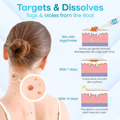 ✅ ODEIUN™ Professional Mole Removal Serum – Trusted Dermatological Formula 🩺