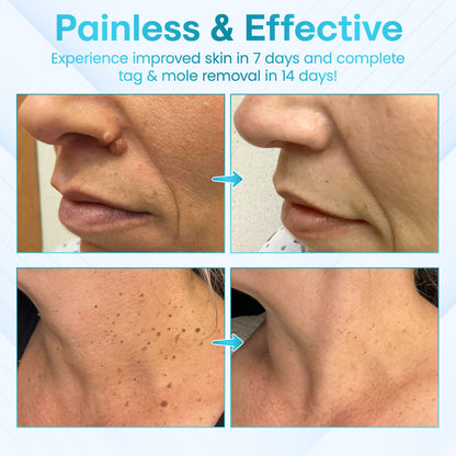 ✅ ODEIUN™ Professional Mole Removal Serum – Trusted Dermatological Formula 🩺