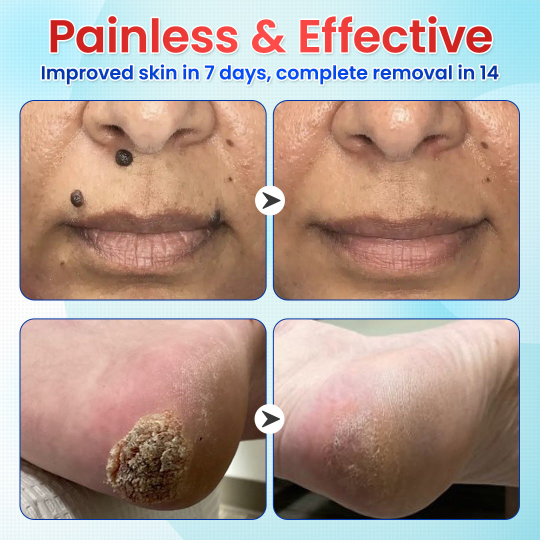 Odeiun™ Clearfrost Cryo Relief Spray🔥 – Advanced Wart & Skin Tag Removal Solution