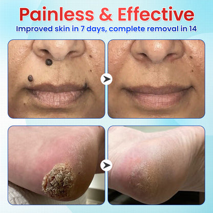 Odeiun™ Clearfrost Cryo Relief Spray🔥 – Advanced Wart & Skin Tag Removal Solution