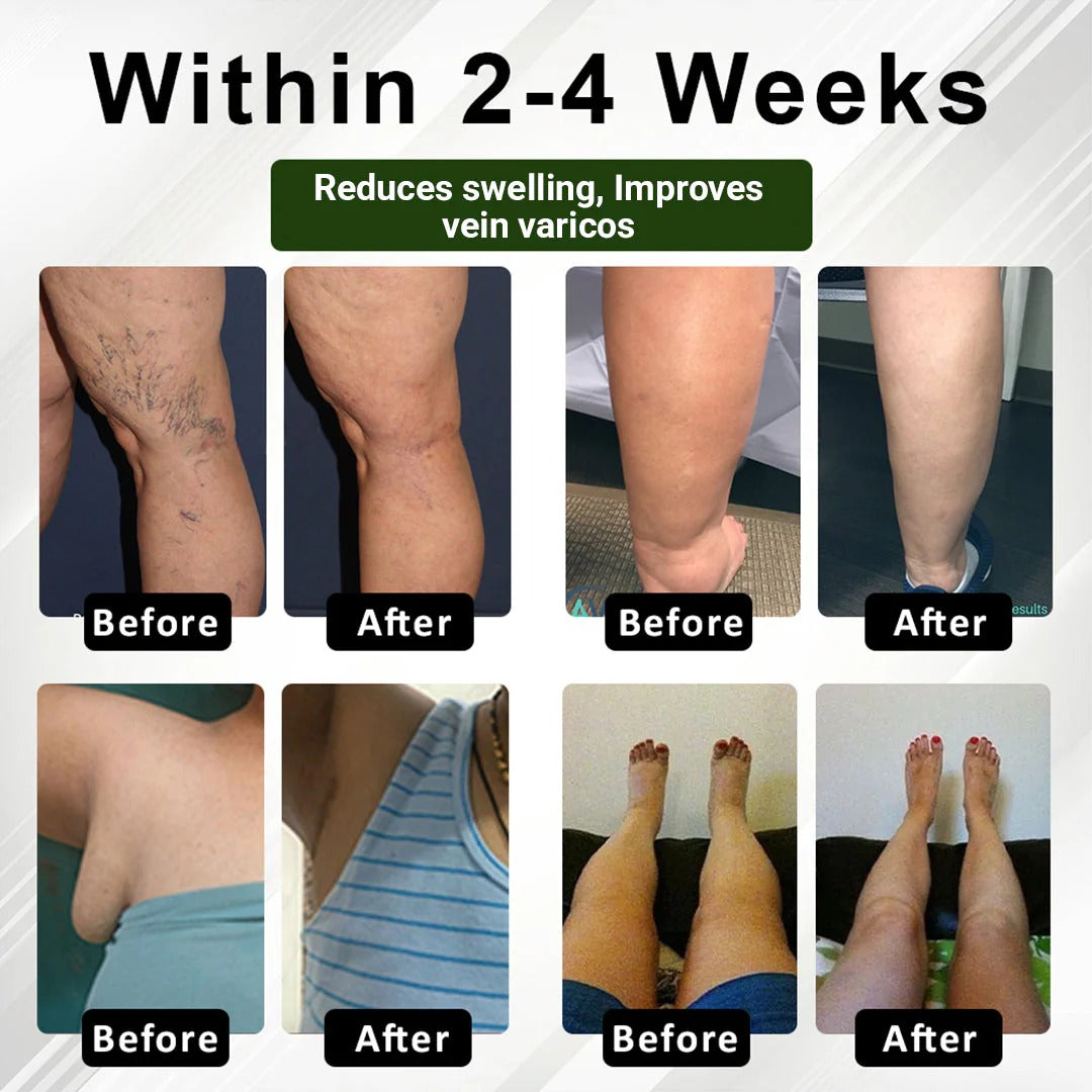 Zakdavi™ FluidEase Leg Therapy Cream | Reduce Swelling, Improve Circulation